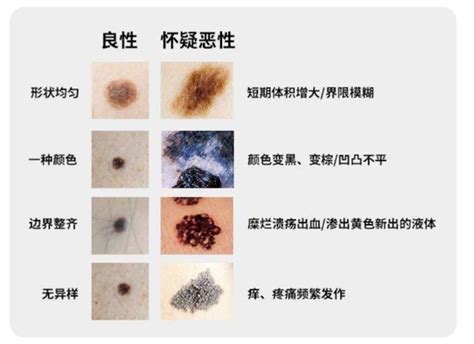 黑痣癌变早期|点痣不正规可能引发癌变：关于痣的 4 个常识